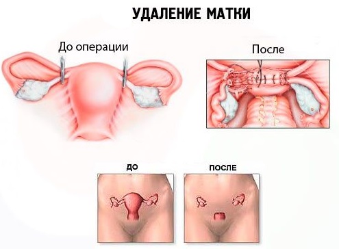 Гормонозаместительная терапия для женщин после 40, 50, 60 лет, при климаксе, ГЗТ после удаления матки и яичников. Фитотерапия, препараты: за и против