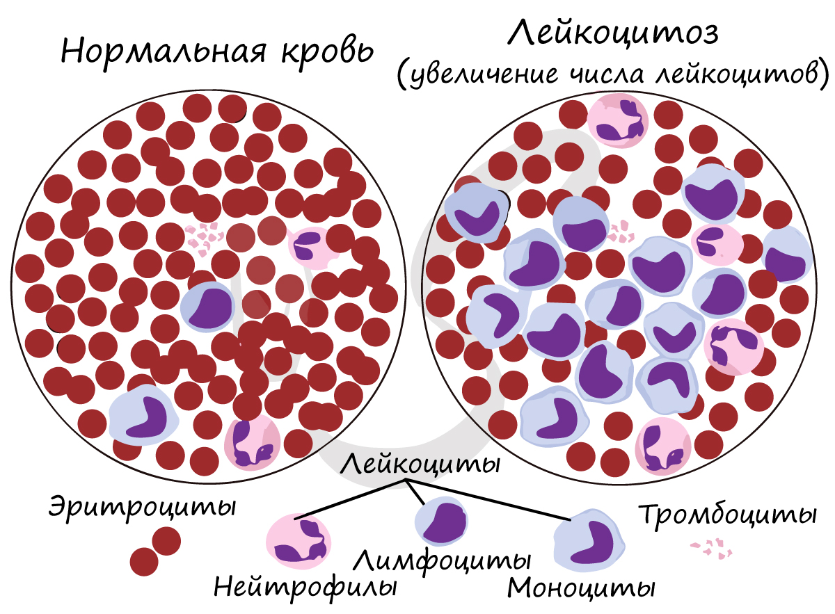 Нормальная кровь и лейкоцитоз